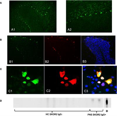 Identification of SKOR2 IgG as a novel biomarker of paraneoplastic neurologic syndrome